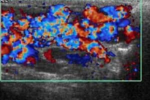 Scrotal ultrasonography of varicocele