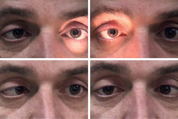 Syndrome de Miller-Fisher chez un patient de 35 ans présentant une mydriase aréactive bilatérale (1 et 2) ainsi qu'une paralysie oculaire avec lévo- et dextroversion des yeux
