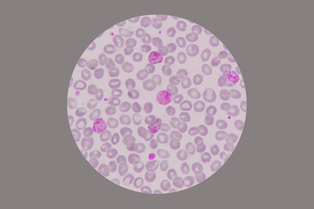 Mikroskopische Untersuchung von Blutausstrichen von mit Malaria infizierten Patienten