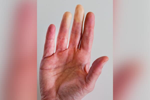Main présentant une décoloration due au syndrome de Raynaud