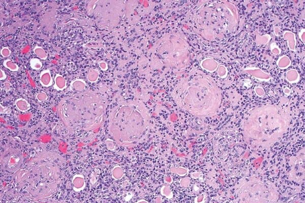 Mikroskopische Aufnahme einer CKD-Progression
