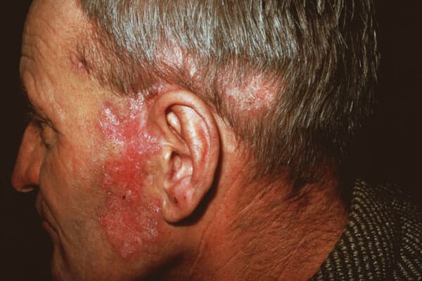 Homme avec lupus Éruption cutanée sur la joue près de l'oreille
