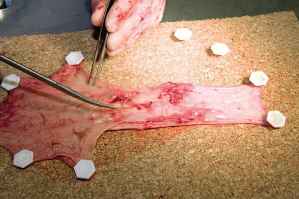 Opération du cancer de l'œsophage