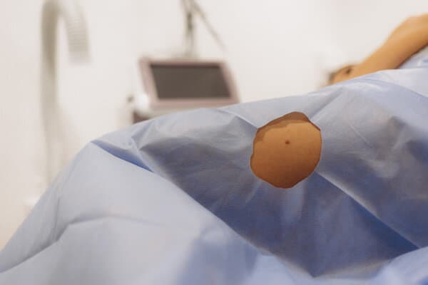 Abgedeckter Patient bereit zur chirurgischen Entfernung eines Muttermals