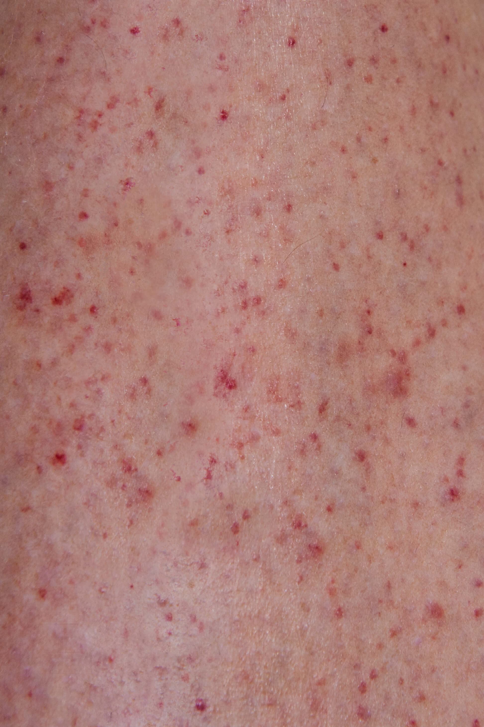 Close up of petechiae rash on a leg