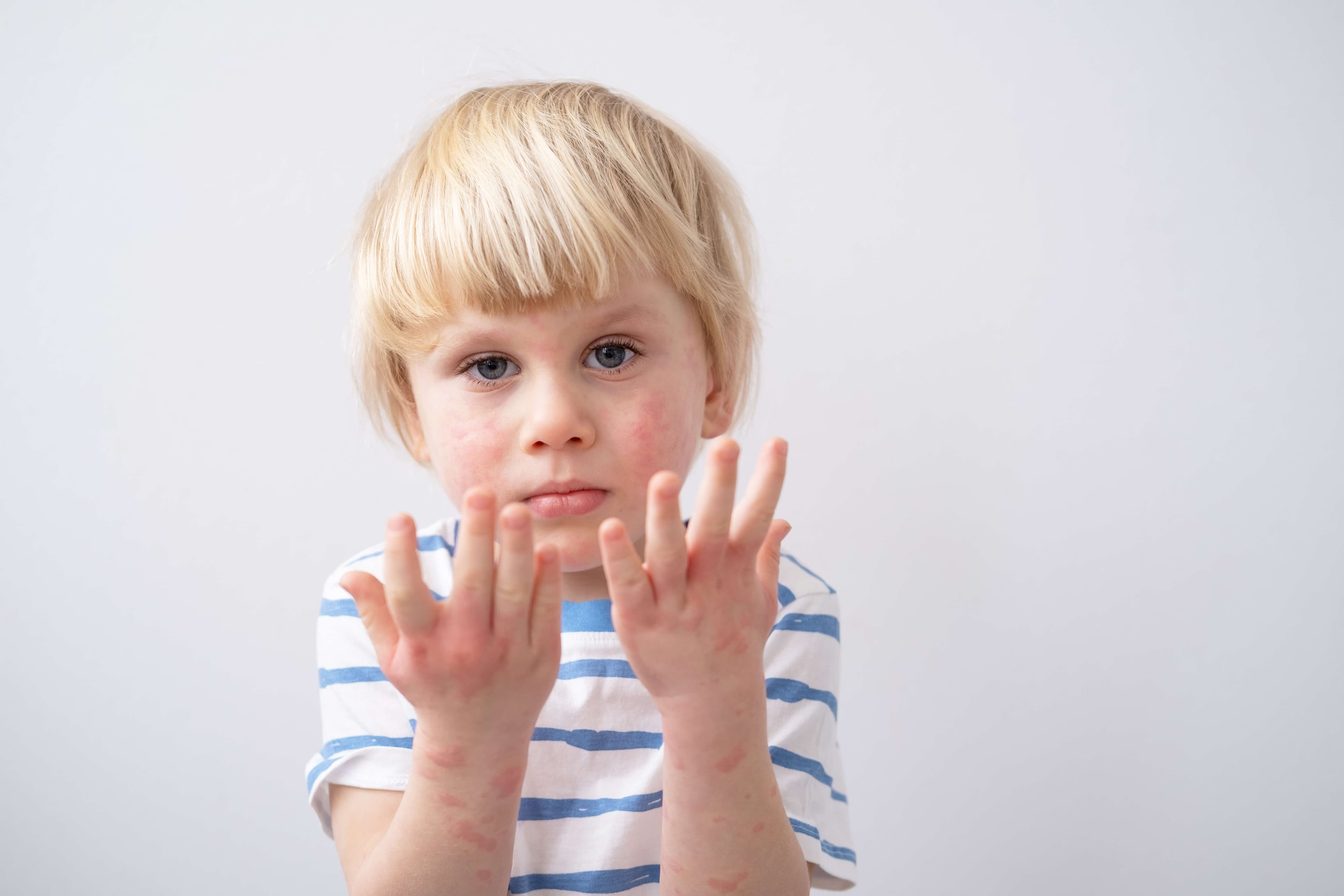little boy with allergic rash or eczema on face and hands. severe allergic reaction, atopic skin.