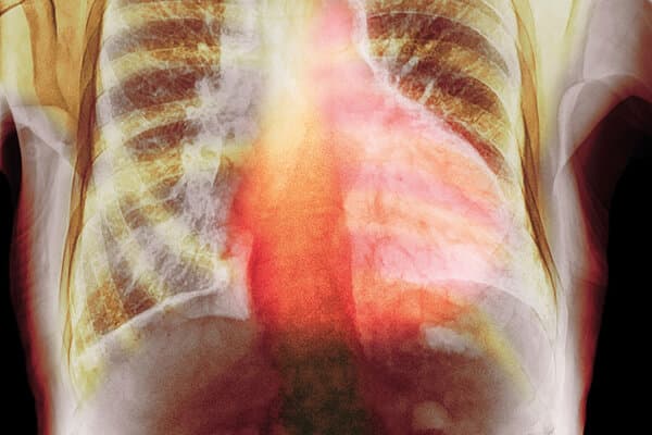 Radiographie d'un thorax atteint de cardiomyopathie
