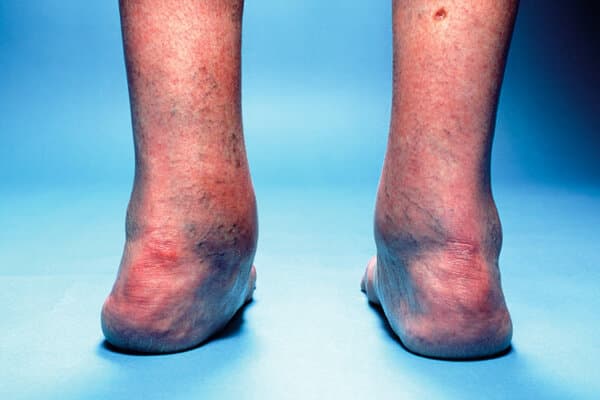 Füsse mit Valgus-Fehlstellung aufgrund rheumatoider Arthritis.