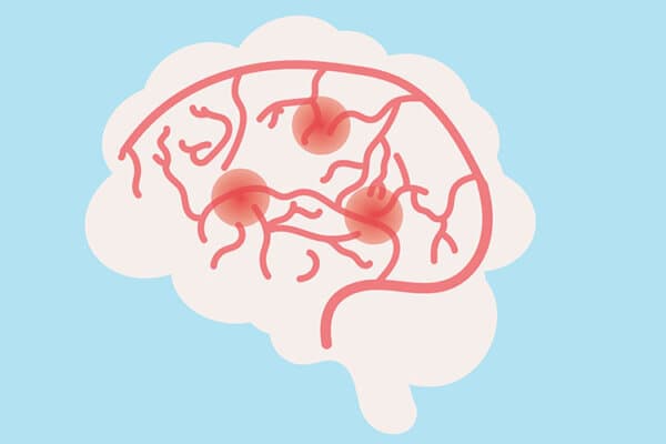 Einfache Illustration eines menschlichen Gehirns transitorischer ischämischer Attacke (TIA) auf blauem Hintergrund.