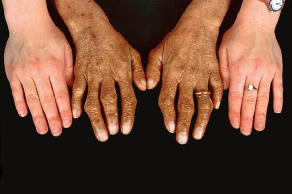 Comparaison de quatre mains atteintes d'hémochromatose