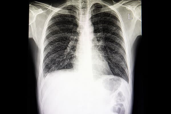 Radiographie thoracique d'un patient atteint d'une maladie pulmonaire interstitielle et d'un épanchement pleural droit.
