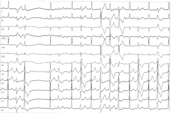 Ein EKG der ein Long QT Syndrom Typ 7 zeigt
