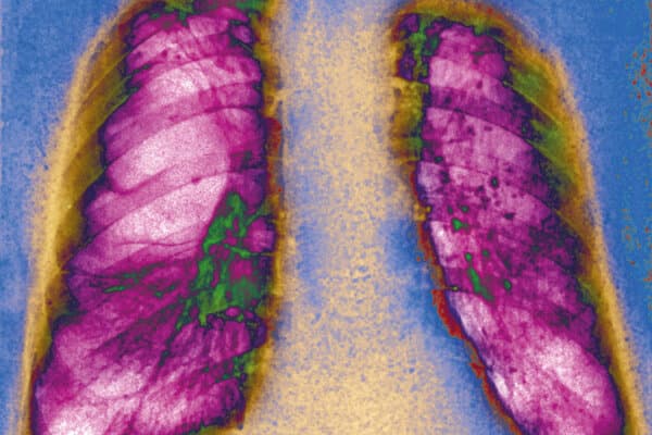Radiographie d'un emphysème pulmonaire.