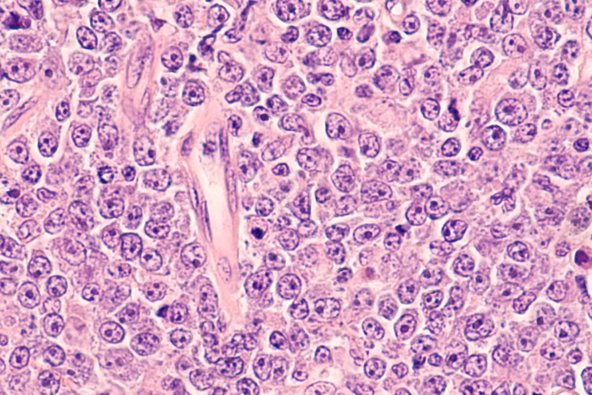 Diffuses grosszelliges B-Zell-Lymphom