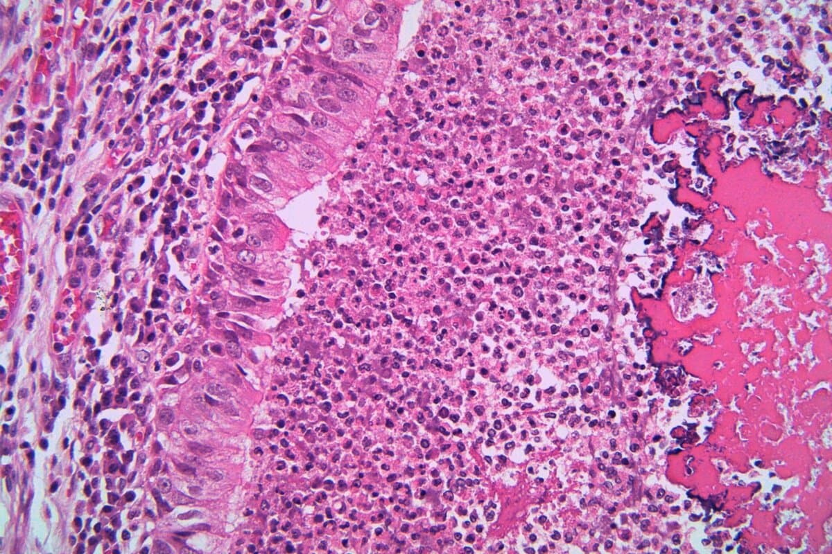 Mikroskopische Aufnahme der zystischen Fibrose.