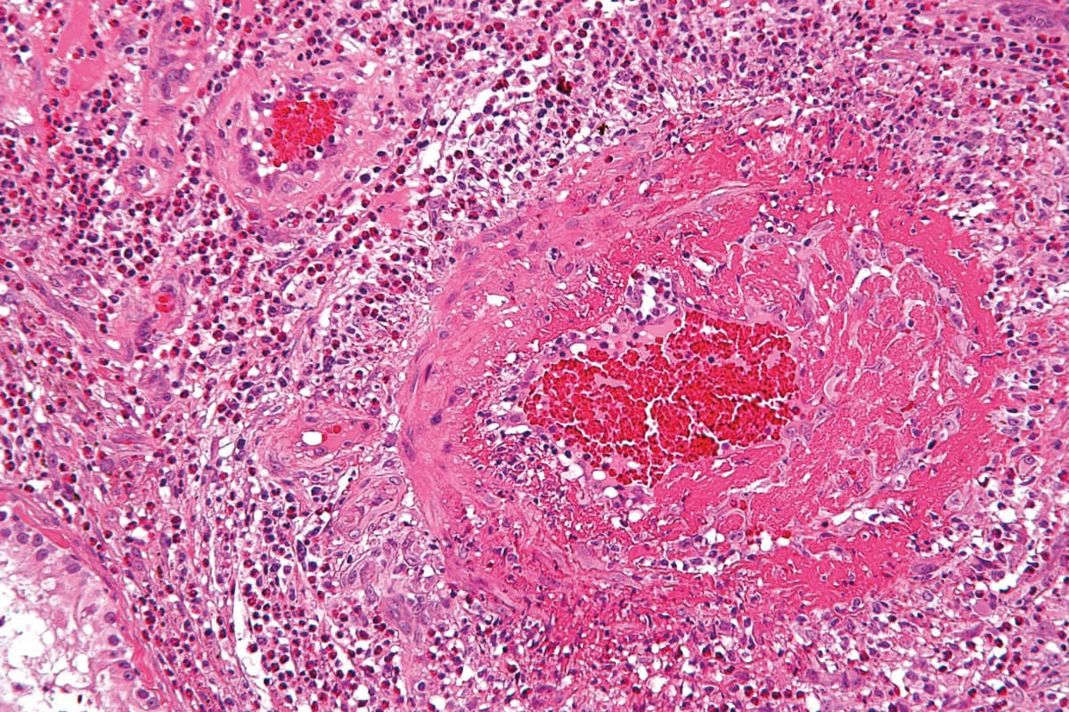 Churg Strauss Syndrome