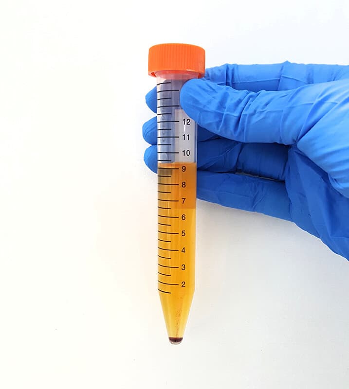Hand mit blauem Plastikhandschuh hält eine Urinproben zur Analyse im Labor. Rote Blutkörperchen im Urin