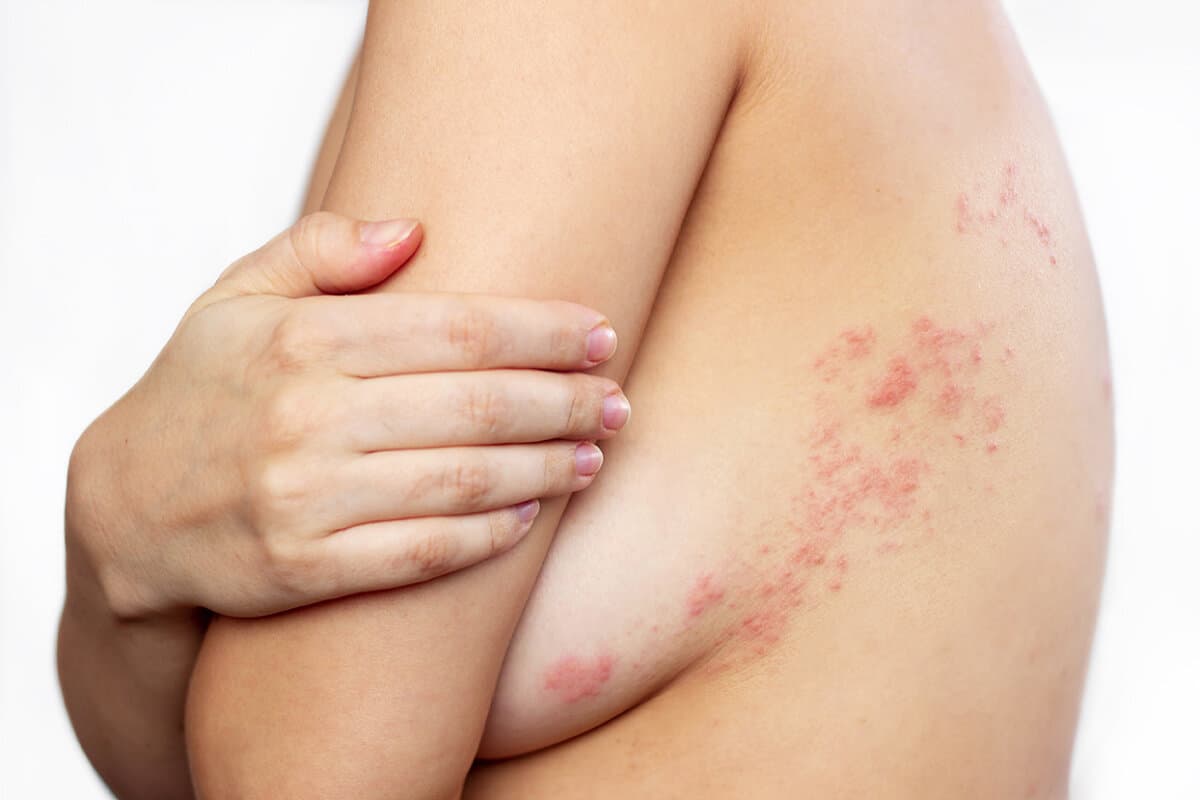 Herpes zoster. Durch Viren verursachte Blasen auf dem Körper einer jungen Frau.