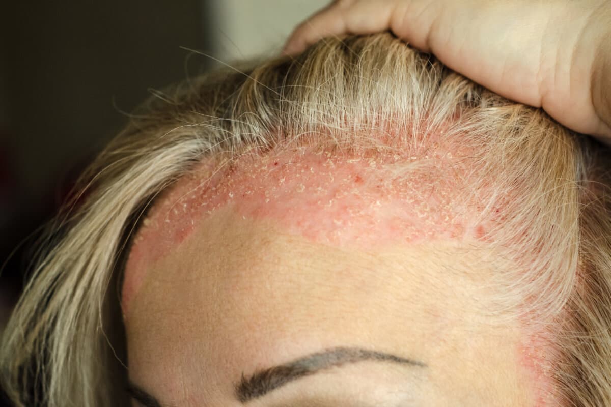 Dermatologische Hauterkrankungen. Schuppenflechte, Ekzeme, Dermatitis, Allergien. Hautläsionen am Kopf.