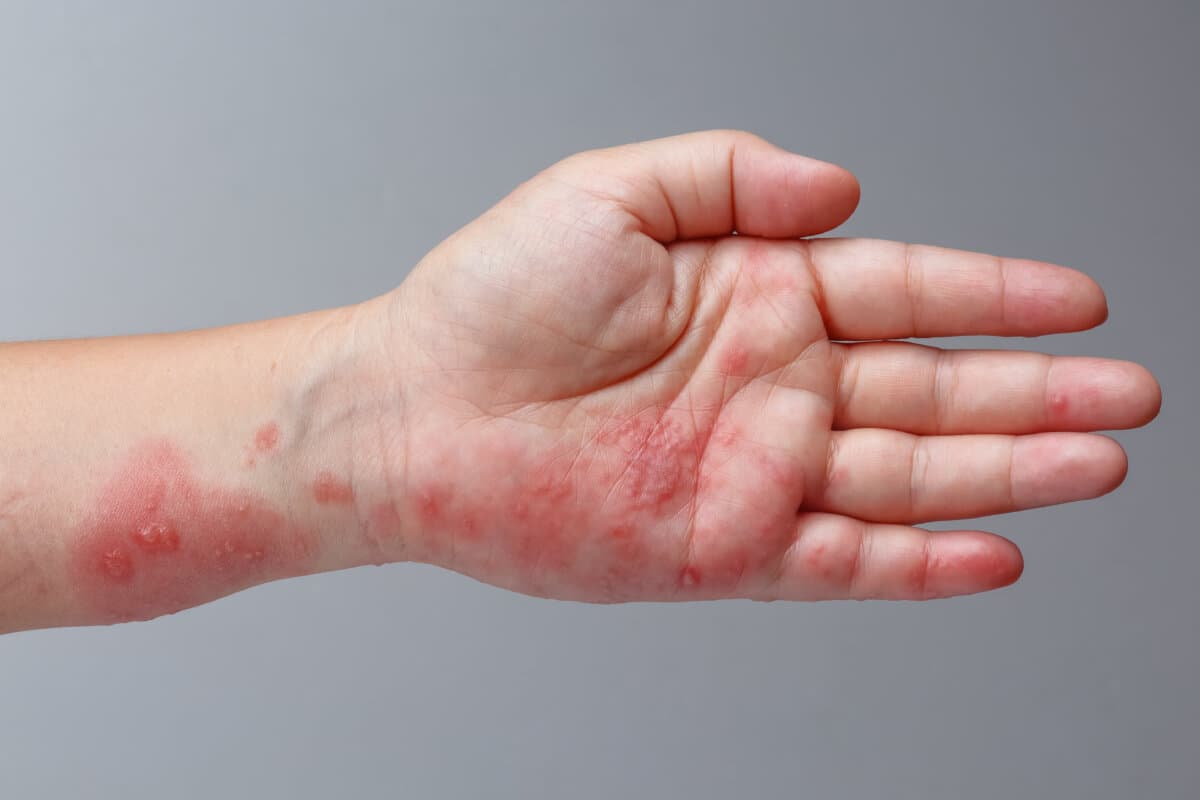 Gürtelrose, Zoster oder Herpes Zoster-Symptome am Arm