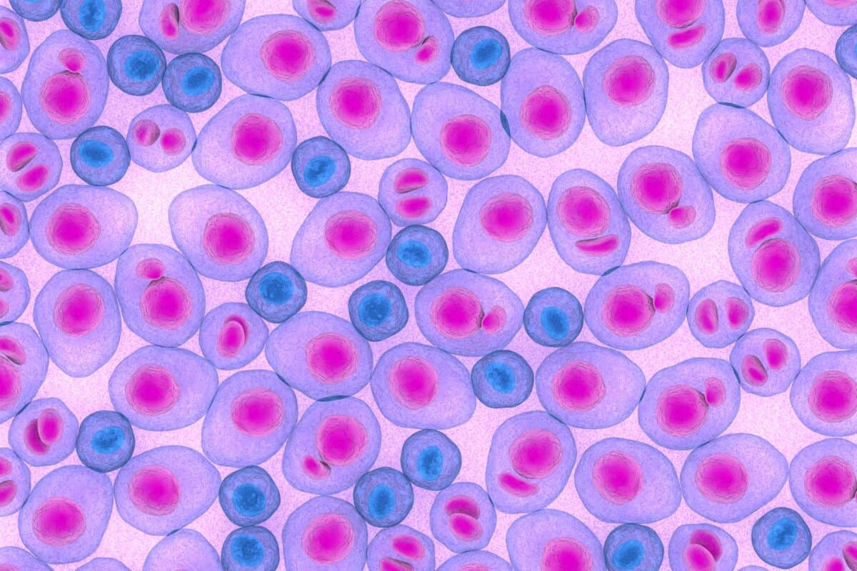 Multiples Myelom, Krebszellen, 3D-Rendering