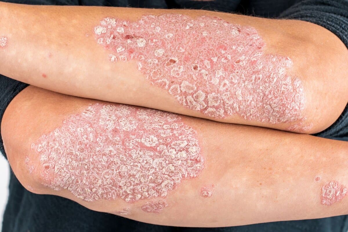Mann mit ausgeprägter Psoriasis vulgaris und schuppiger, entzündeter Haut an den Händen.