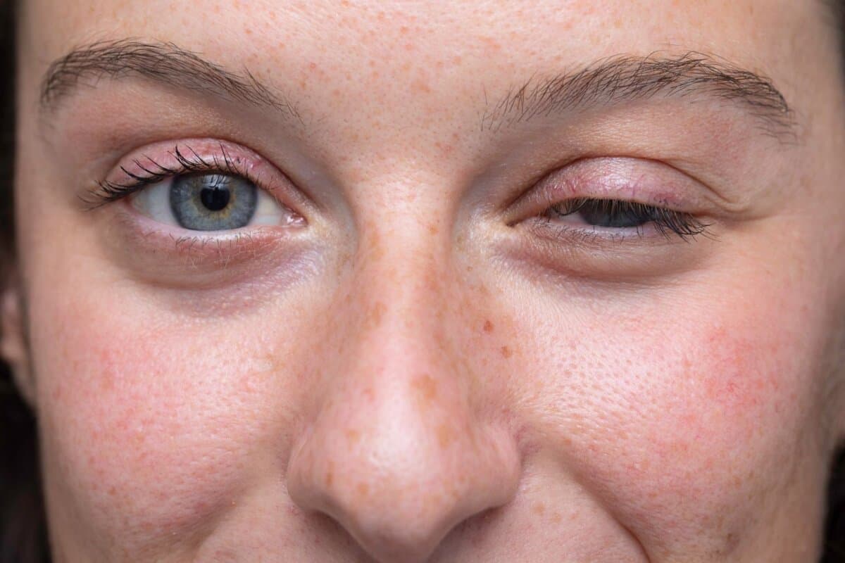 Nahaufnahme eines Mädchengesichts mit blauen Augen, eines halb geschlossen – Myasthenia-gravis-Erkrankung.