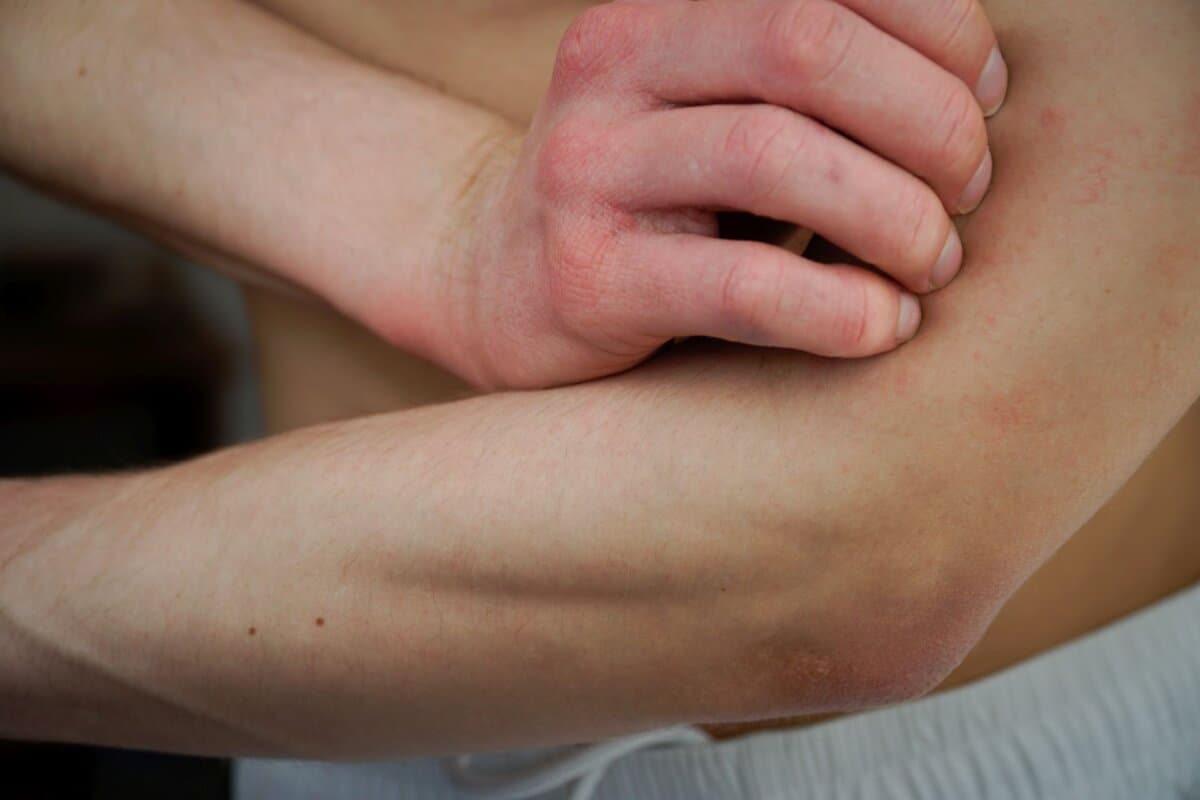 Dermatitis ist eine sehr unangenehme Krankheit, die ständigen Juckreiz auslöst.