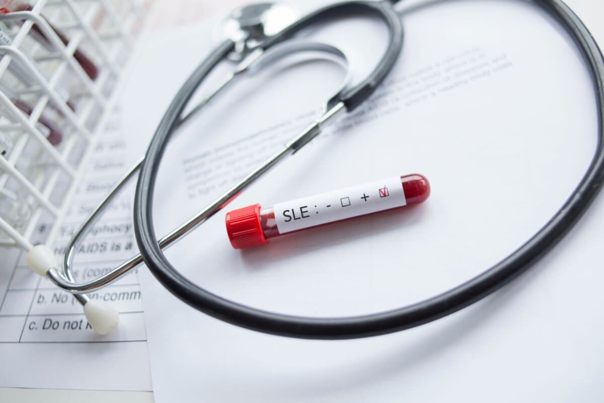 Laborbefund: Blutprobe positiv auf systemischen Lupus erythematodes (SLE)