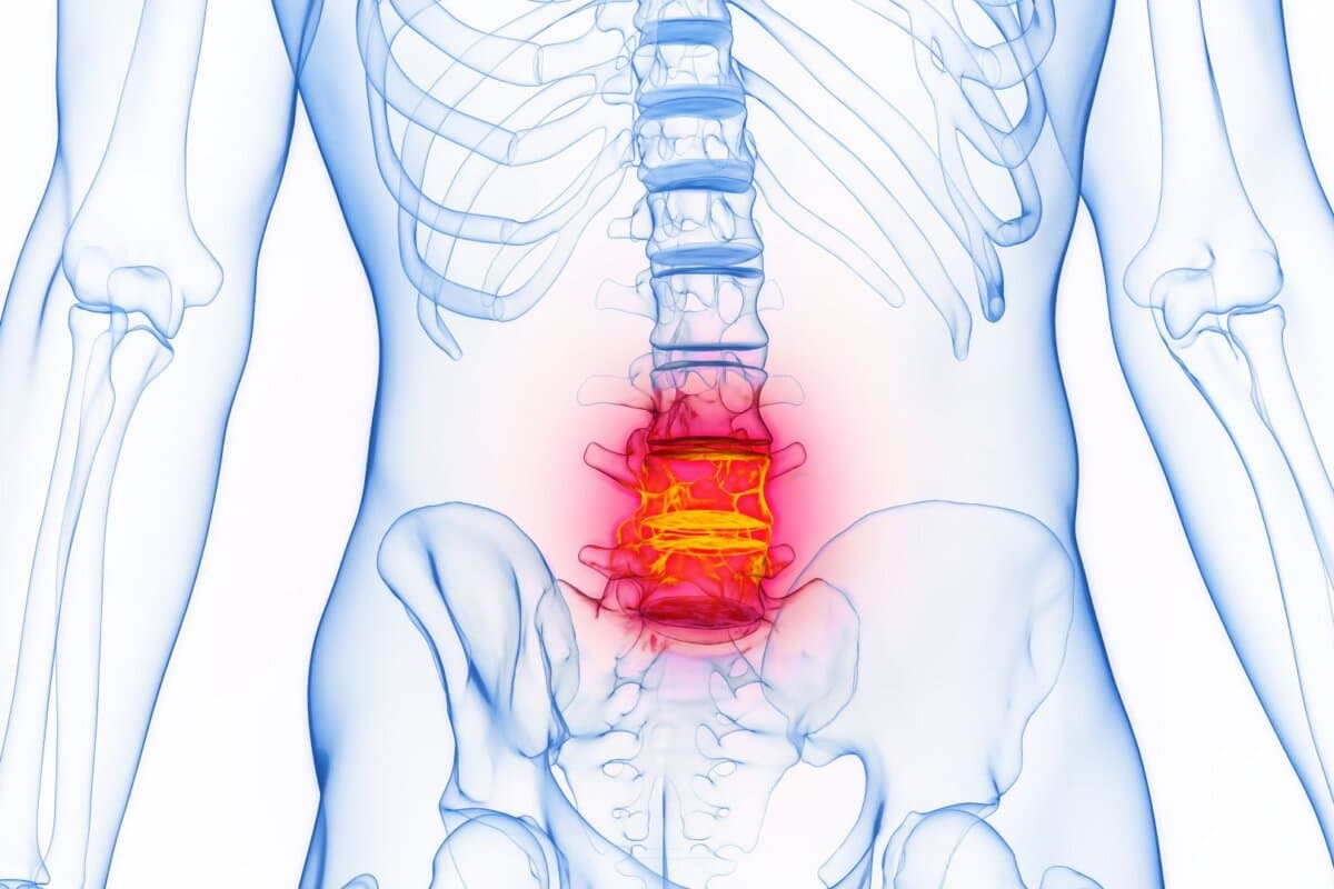Illustration médicale 3D de l'anatomie masculine : colonne lombaire enflammée. Fond blanc uni.