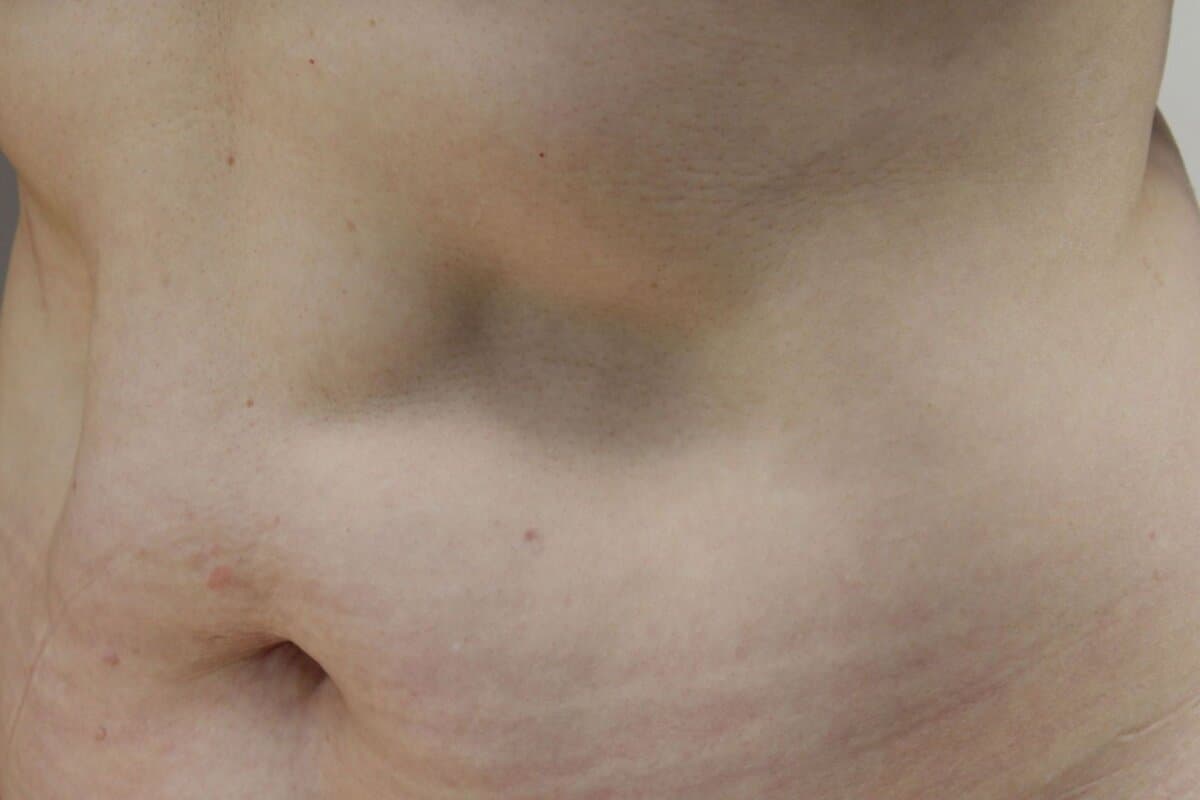 Periumbilikale Lipatrophie