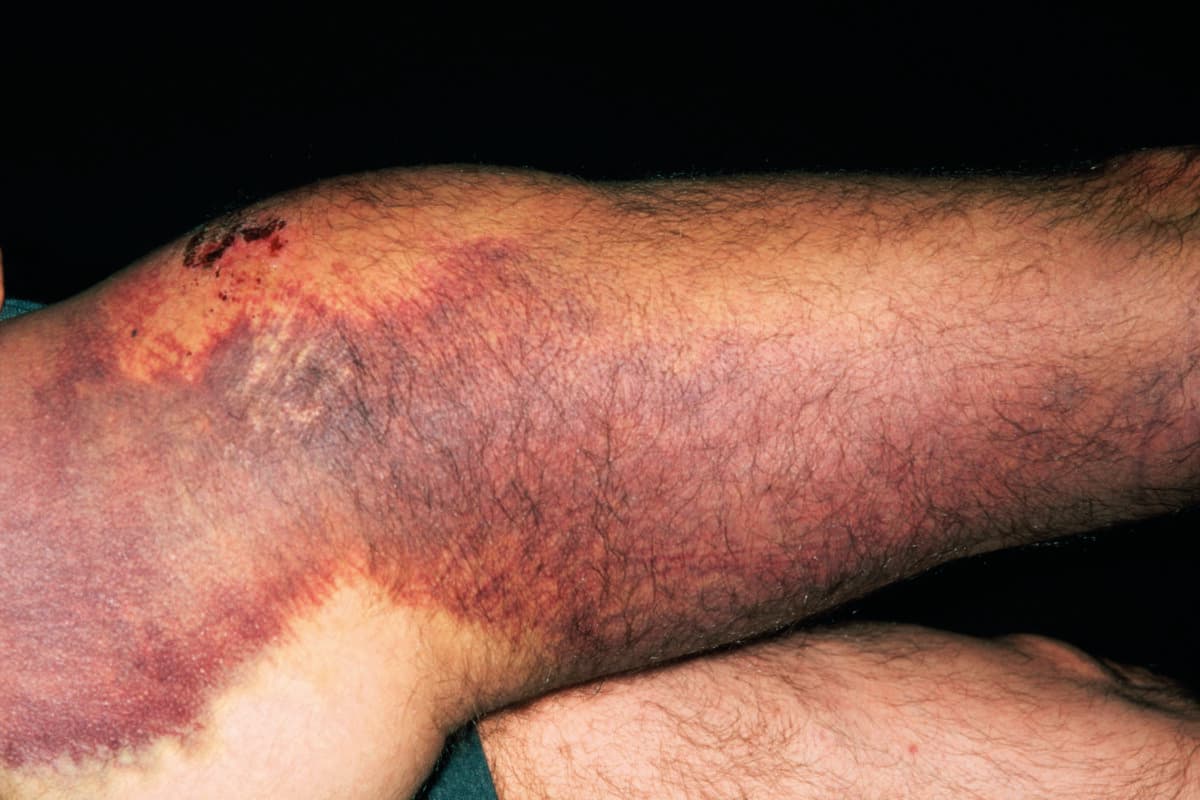 Bein eines 55-jährigen Mannes mit Hämophilie, eine Woche nach einem Fahrradsturz.
