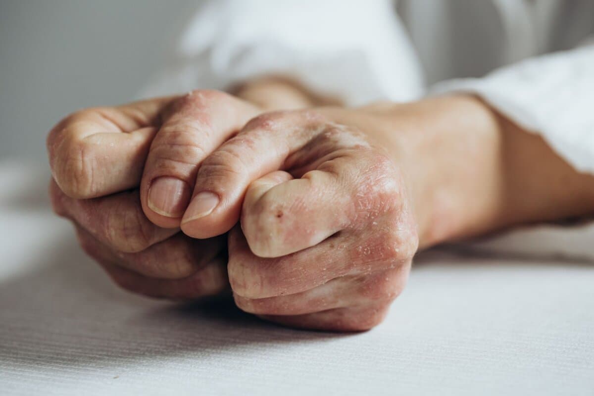 Nicht erkenn­bare junge Frau mit Psoriasis. Grosse, gerötete, entzündete und schuppige Plaques an den Ellbogen.