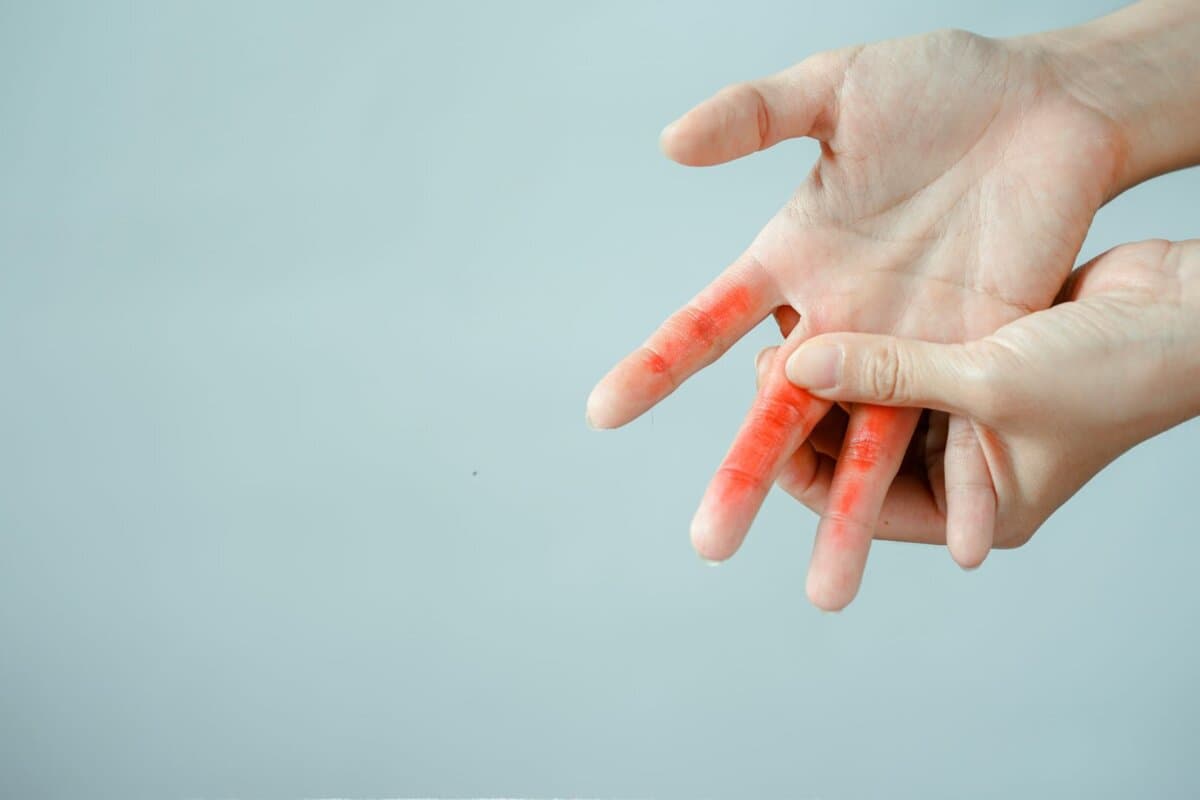Schmerzen in der Hand, Entzündungen in den Fingern, Gelenkbeschwerden und Rötungen