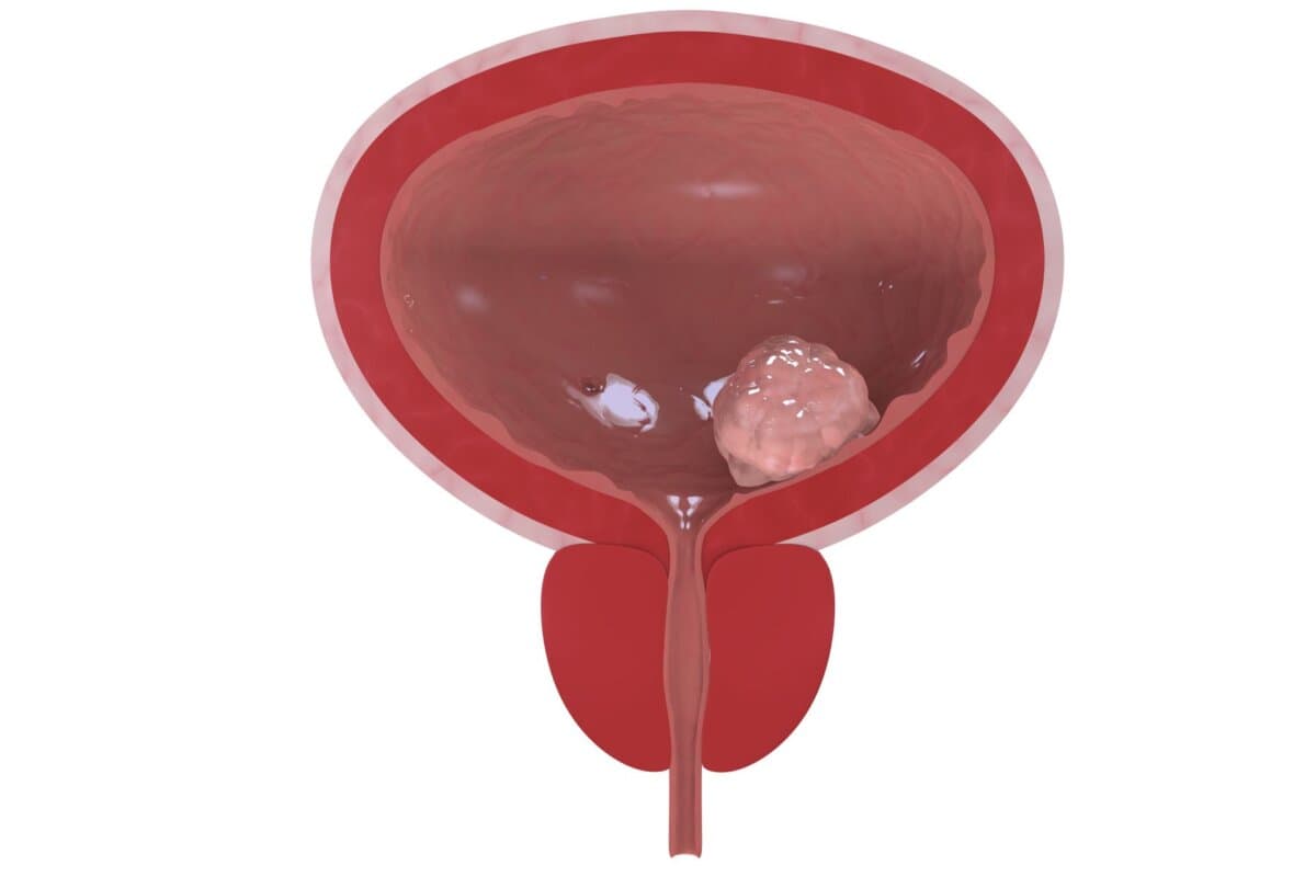 Querschnitt einer Harnblase mit sichtbarem Tumorbefund.