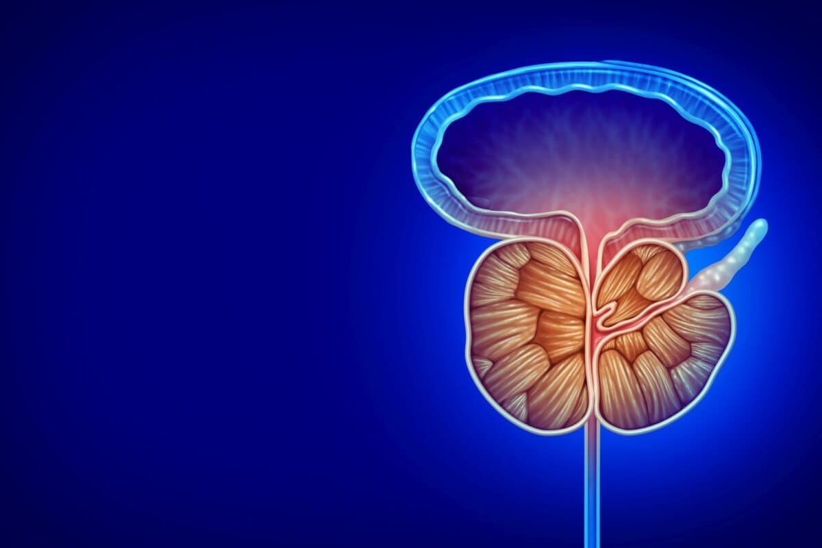 Illustration médicale urologique d'une hypertrophie de la prostate (hyperplasie bénigne de la prostate) faisant partie du