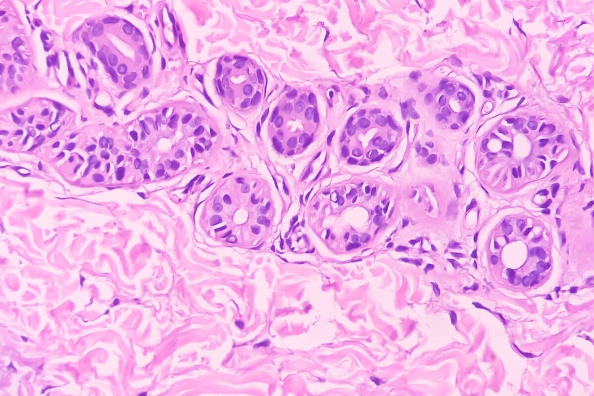 Hautbiopsie an der Hand bei Prurigo nodularis: Mikroskopisch sichtbar sind Hyperkeratose, Acanthose, Hypergranulose und