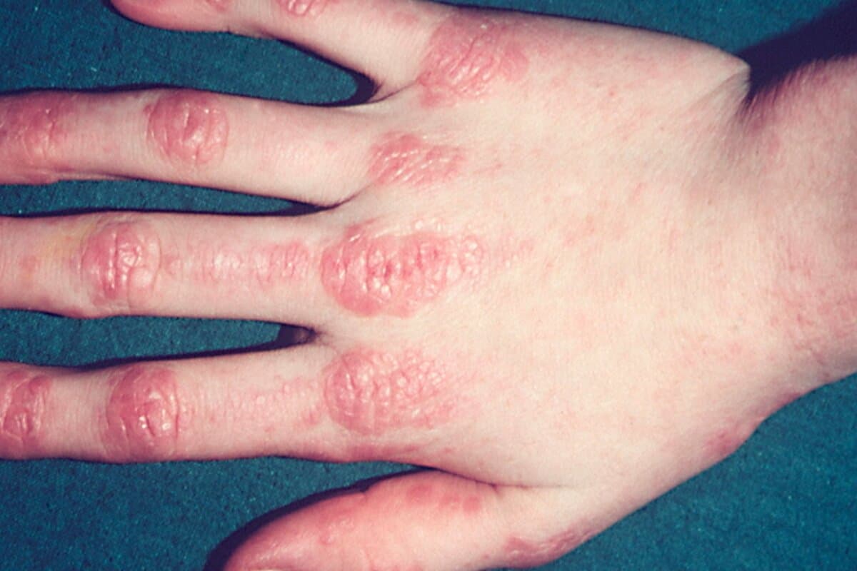 Dermatomyositis