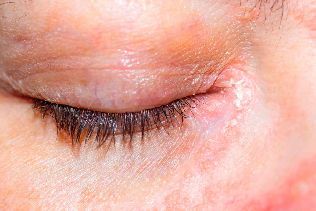 Psoriasis am Auge