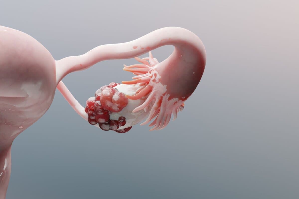 3D-Darstellung eines malignen Ovarialtumors im Kontext der weiblichen Reproduktionsorgane mit tumorösem Zellwachstum und