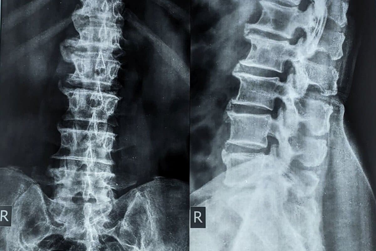 Radiographie de la colonne vertébrale montrant une hyperostose squelettique diffuse idiopathique (DISH, maladie de