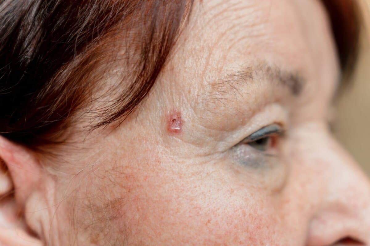 Basalzellkarzinom im Schläfenbereich bei einer älteren Patientin