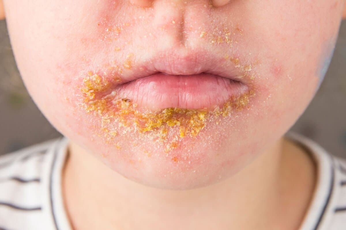 Kind mit Impetigo contagiosa: honiggelbe Krusten bei oberflächlicher bakterieller Hautinfektion.