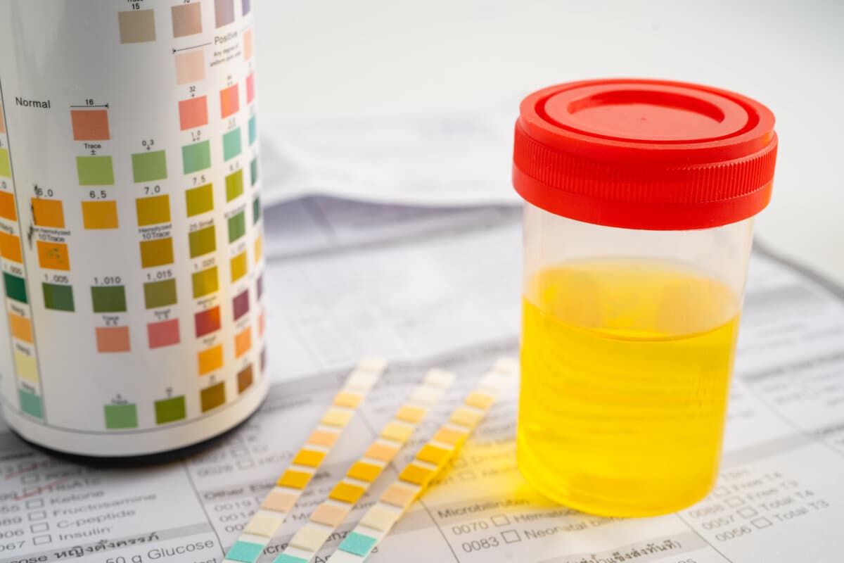 Urinuntersuchung im Labor: Urinstix mit Farbskala zur Bestimmung verschiedener Parameter im Urin.