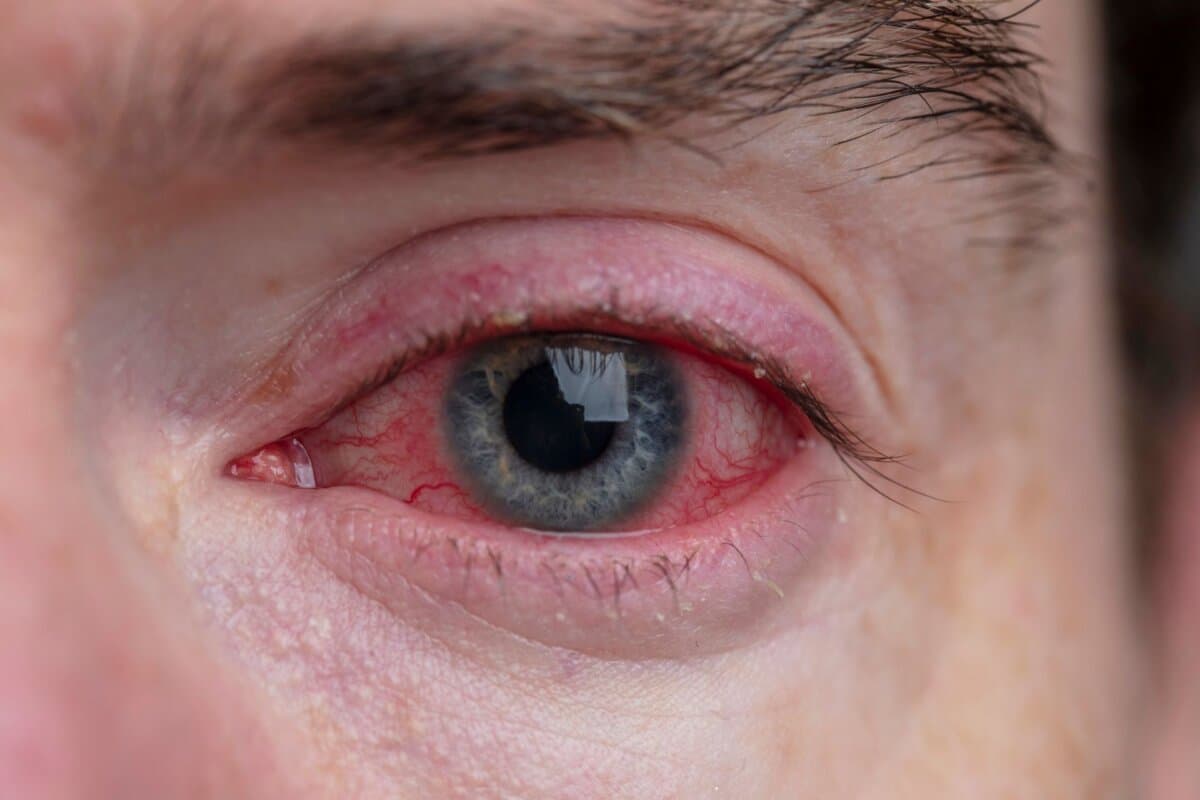 Gerötetes Auge bei entzündlicher Augenbeteiligung, etwa im Rahmen einer Blepharitis oder Konjunktivitis.