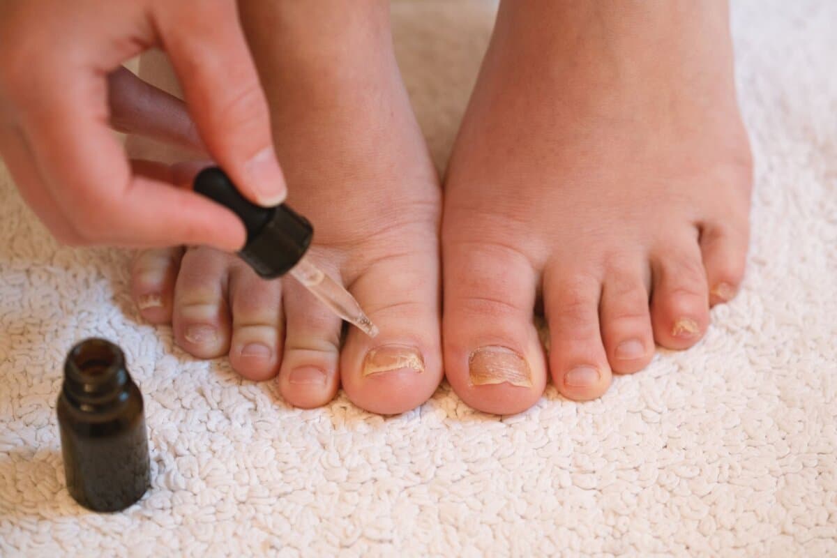 Onychomykose der Zehennägel – eine häufige und oft langwierige Pilzinfektion der Nägel.