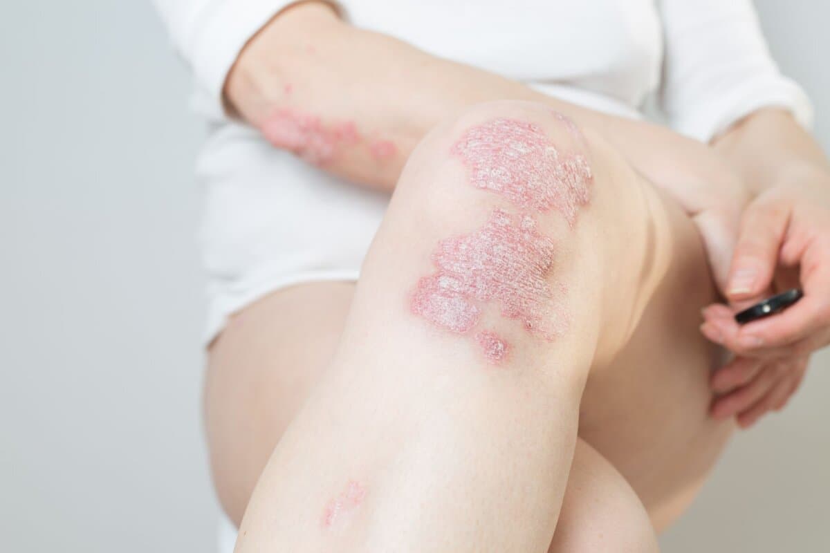 Psoriasis ist eine chronisch entzündliche, immunvermittelte Hauterkrankung, die sich typischerweise an Ellbogen, Knien und