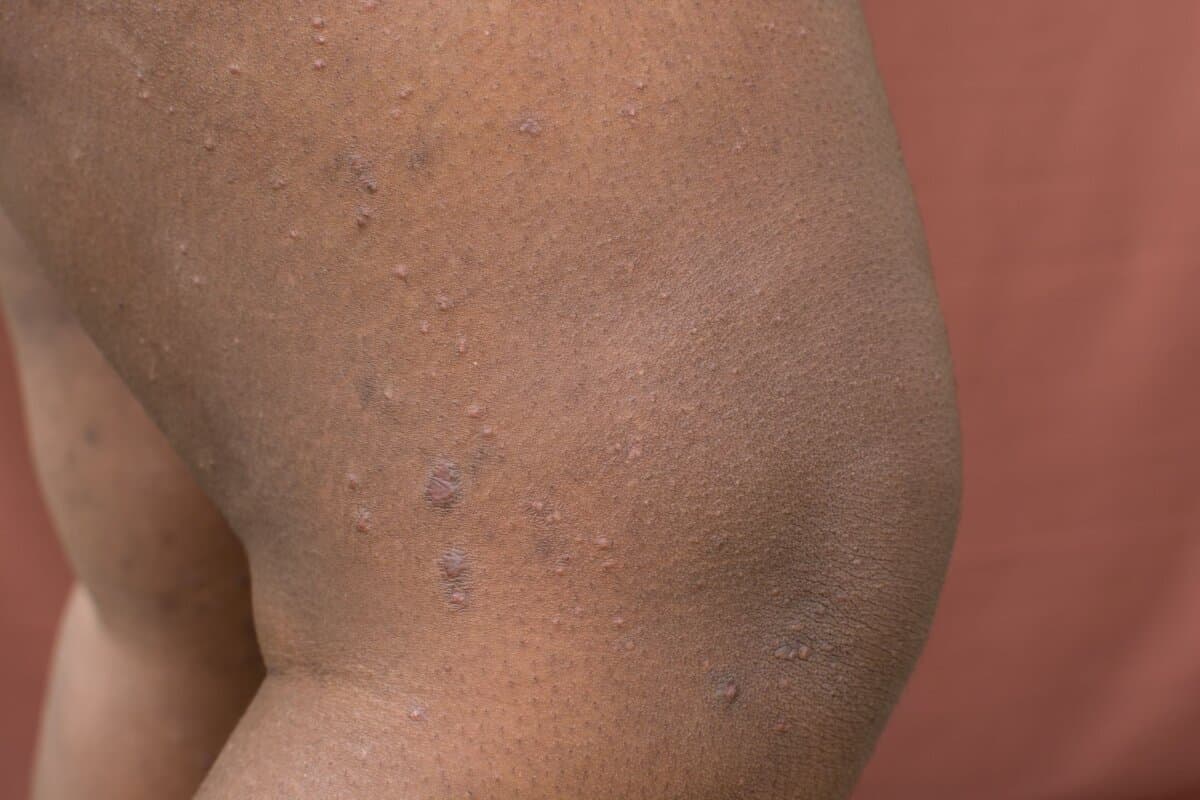 Hautmanifestationen des Prurigo nodularis auf dunkler Haut