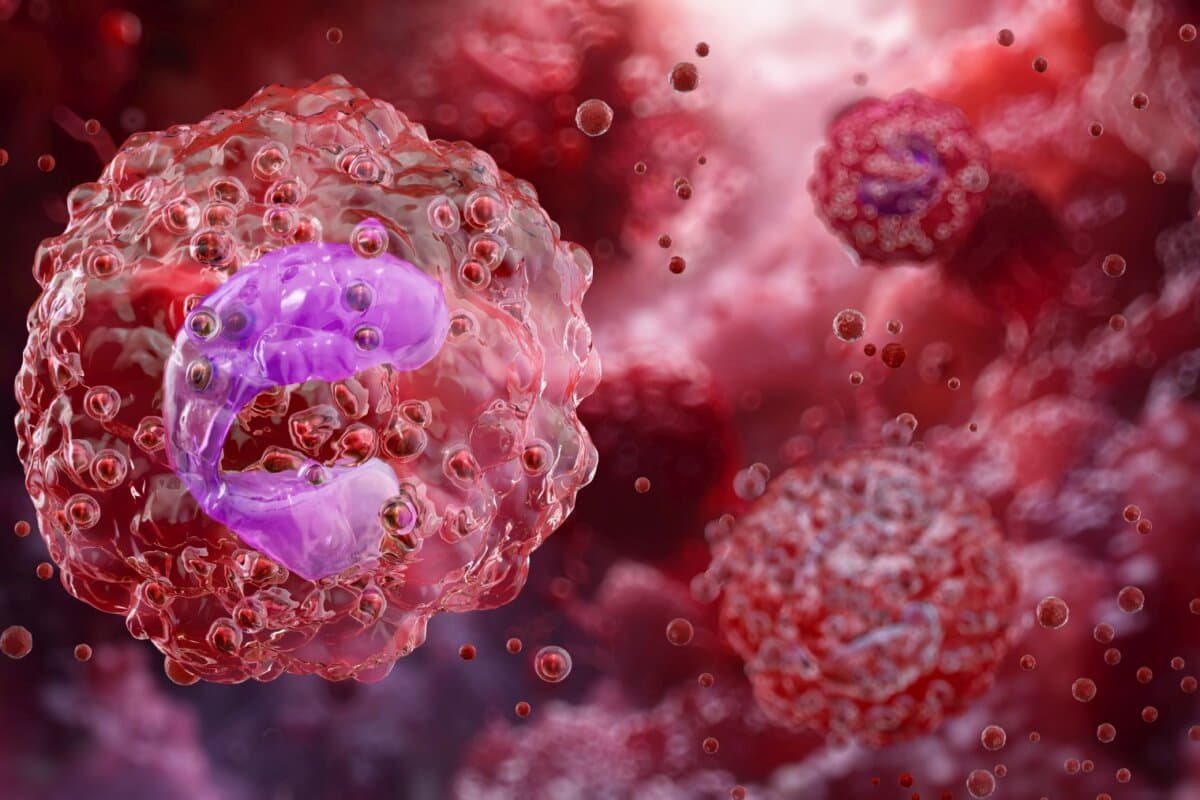 Eosinophiler Granulozyt mit charakteristischem zweilappigem Zellkern und Granula.