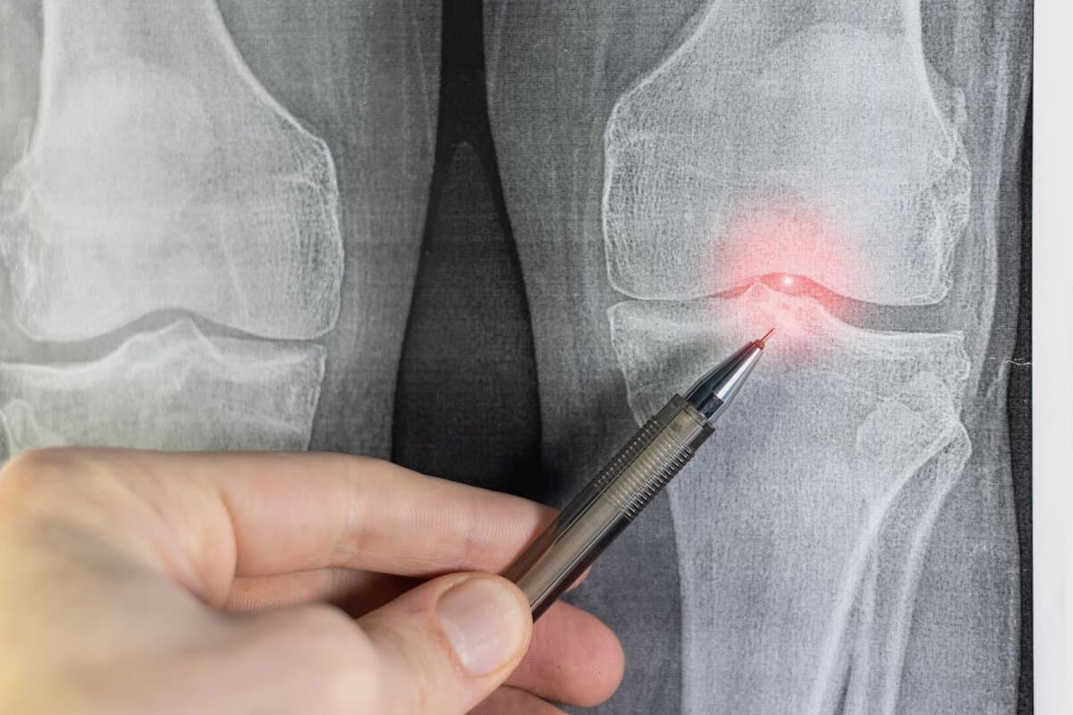 Ärztin analysiert Röntgenaufnahme eines Kniegelenks mit Arthrose.